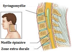 chiari avec syringomyélie